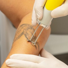 Laser Tattooentfernung Düsseldorf bei Dr. Gerber