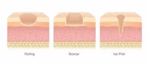 Verschiedene Aknenarben Typen