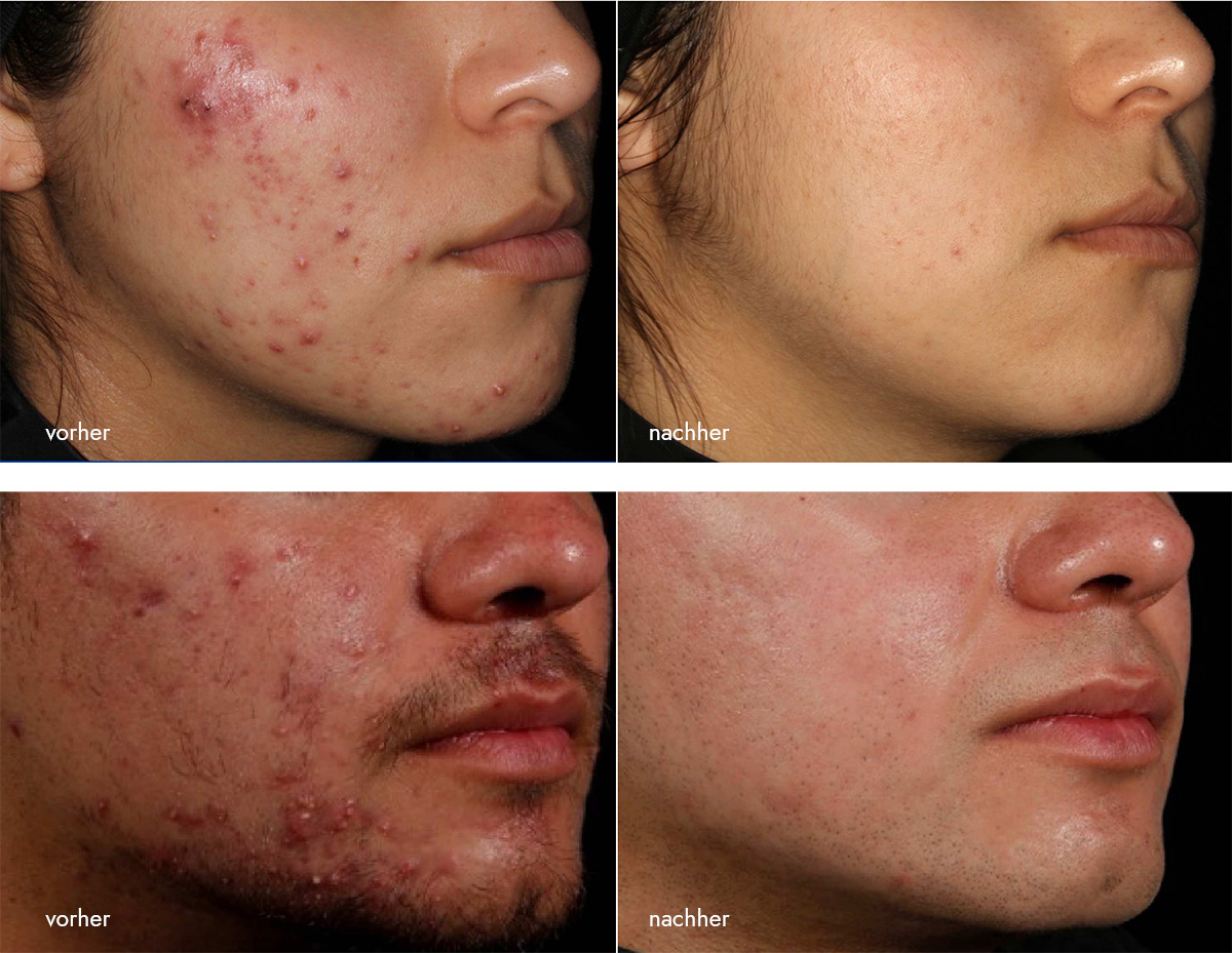 Aviclear Ergebnisse der Aknebehandlung