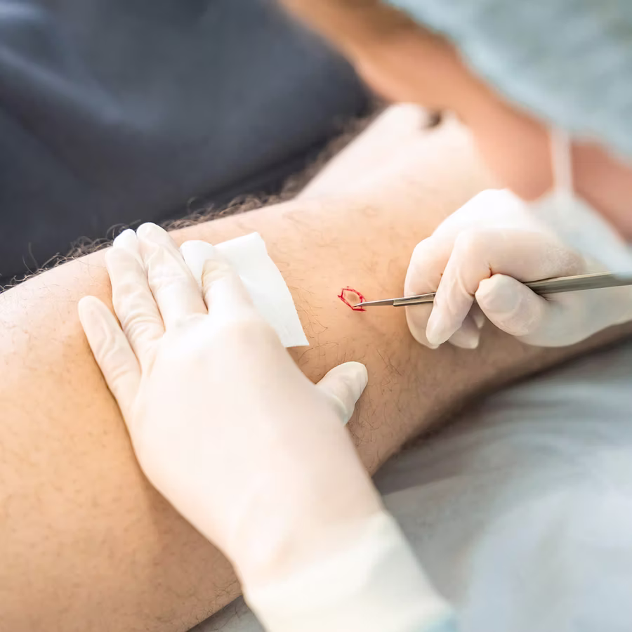 Hautkrebs – Behandlung und Tumor-OP