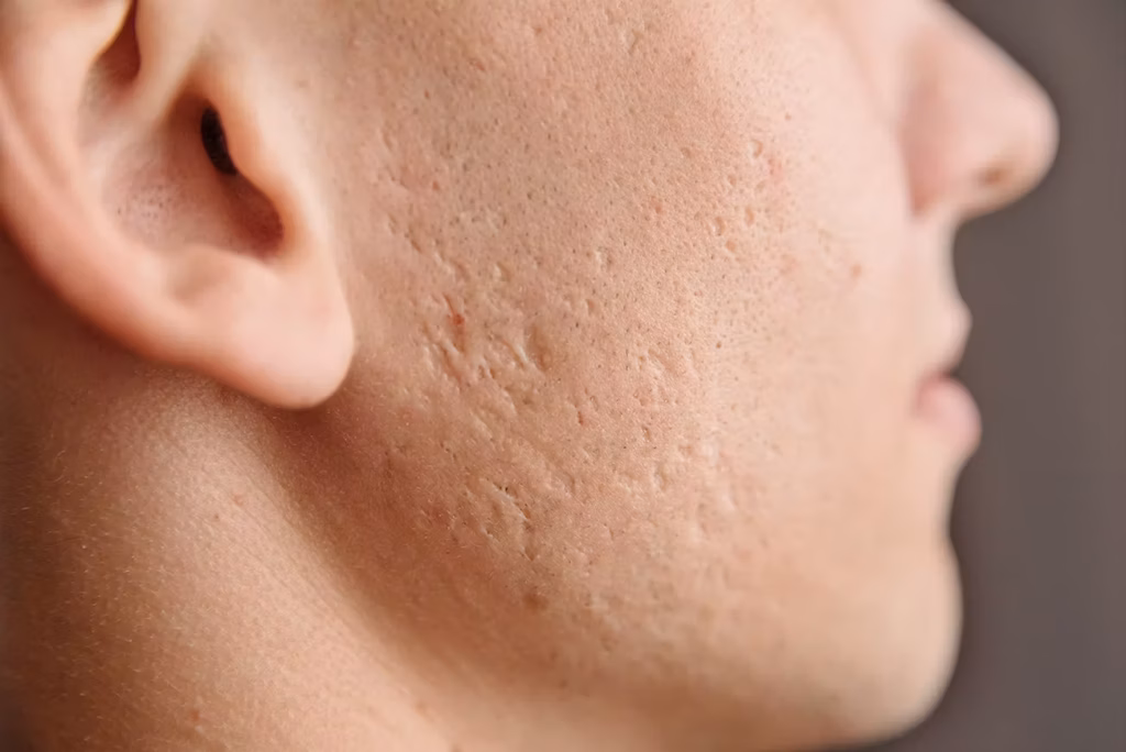 Aknenarben: Welche Behandlung bei welchem Narbentyp